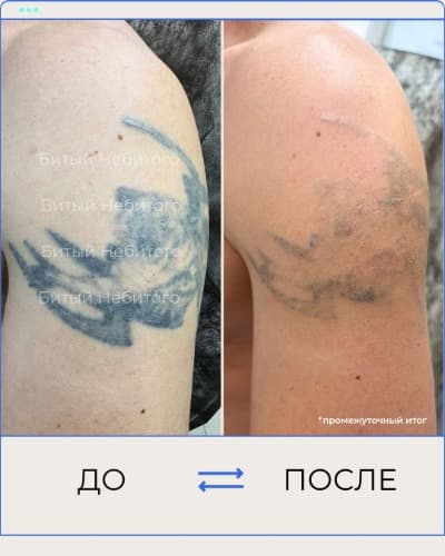 Удаление татуировки